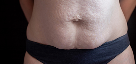 Operación de diástasis abdominal en el seguro