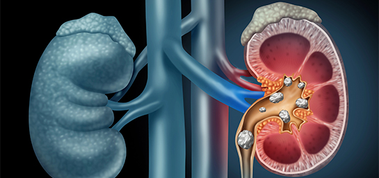¿El Seguro de Salud de MAPFRE cubre la eliminación de piedras en el riñón?