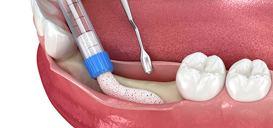 Injerto de encía en el seguro dental de Mapfre