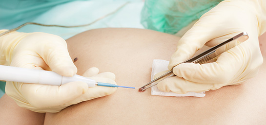 Eliminación de lunares en el Seguro de Salud